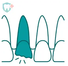 Illustration of a broken chipped tooth highlighted in teal next to healthy teeth.