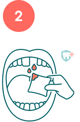 Diagram showing hand using gauze to stop bleeding from a knocked out tooth socket.