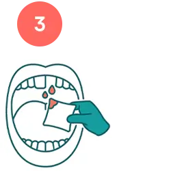 Illustration of a hand pressing gauze onto a bleeding knocked out tooth socket.