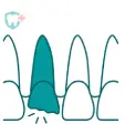 Illustration of a chipped tooth with crack lines next to healthy teeth.