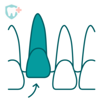 Illustration of a tooth pushed into the gum after a dental injury