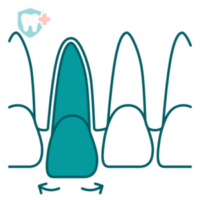 Illustration of a loose tooth after a dental injury