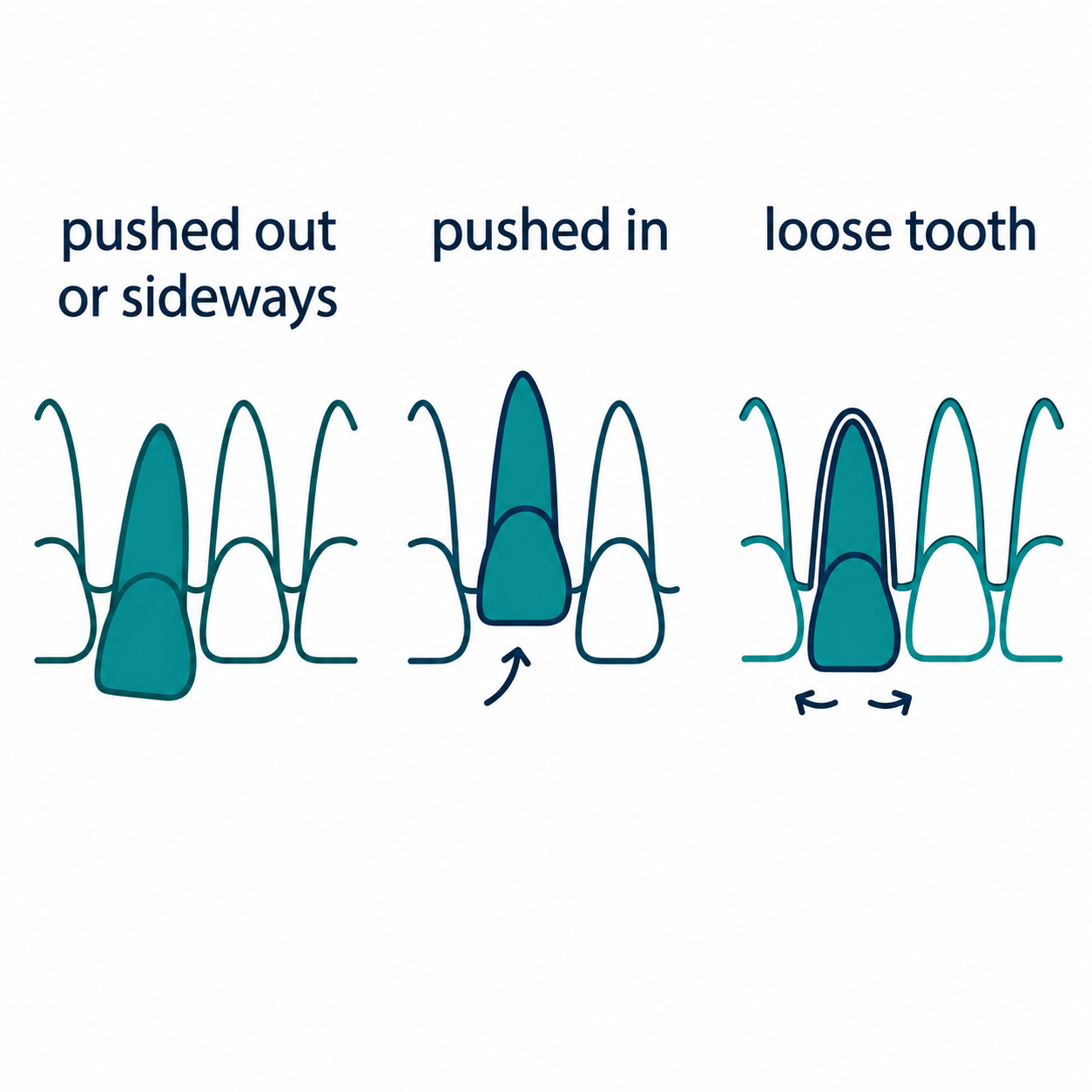 Three simple diagrams showing a normal tooth alongside pushed-in, pushed-out and pushed-sideways positions